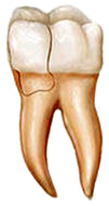 Cracked tooth with fractured cusp