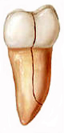 Split tooth