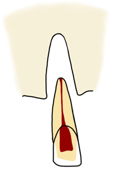 Avulsed / knocked out tooth diagram