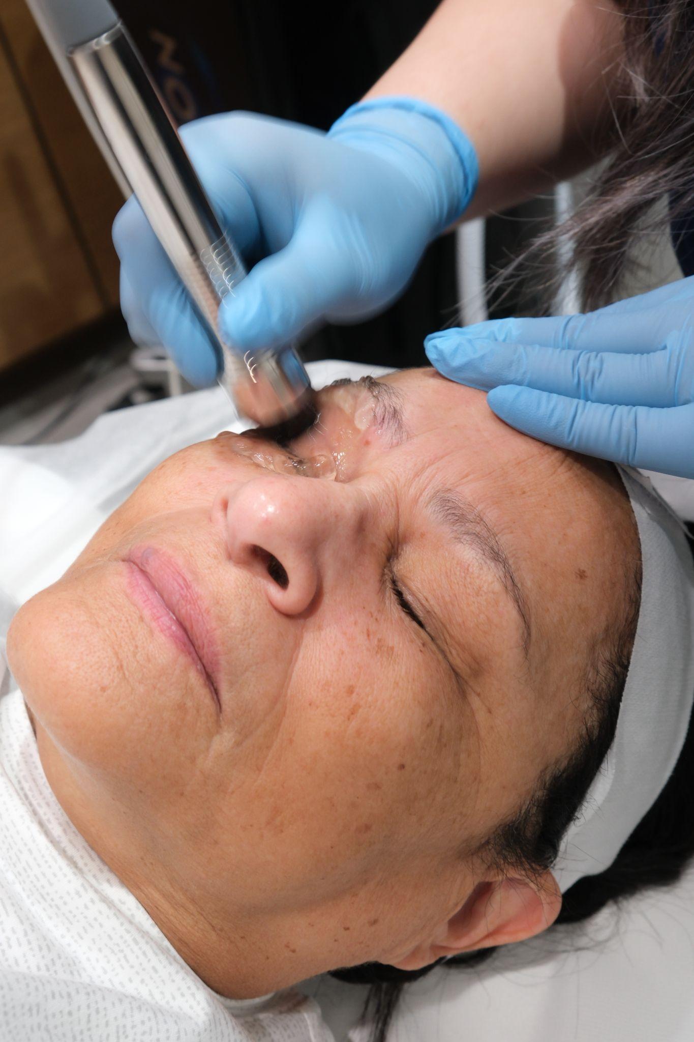 Forma-I treatment at EyeC Optometry