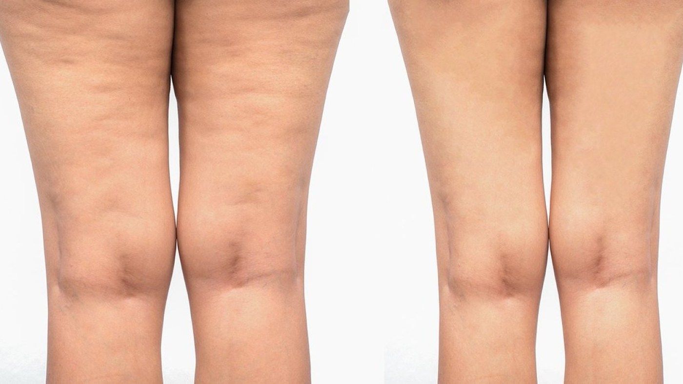 Cellulite Reduction