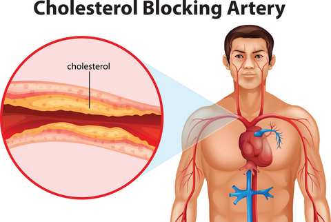 Foto van een bloedvat waarin je cholesterol ziet opgestapeld.