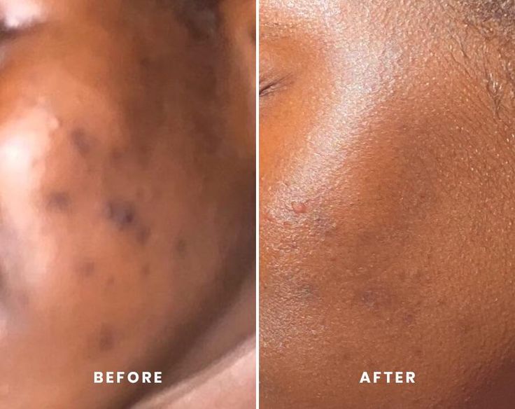 Hyperpigmentation: How To Get Clear Even Skin