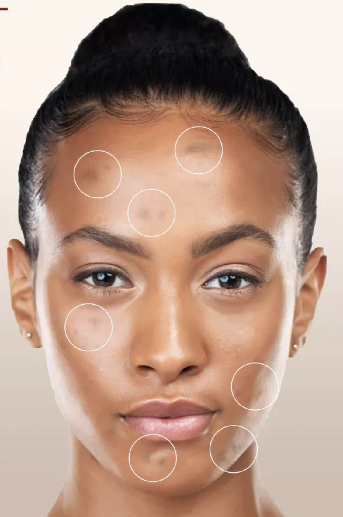 Hyperpigmentation: What Is It and How to Get Rid of It