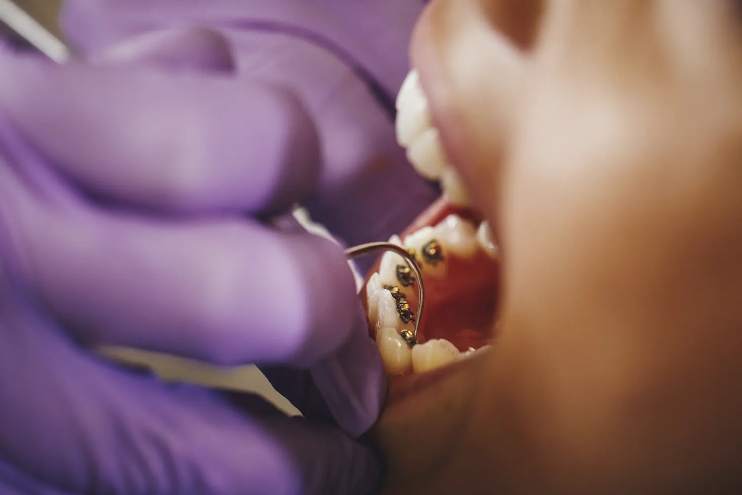 Adult Orthodontics
