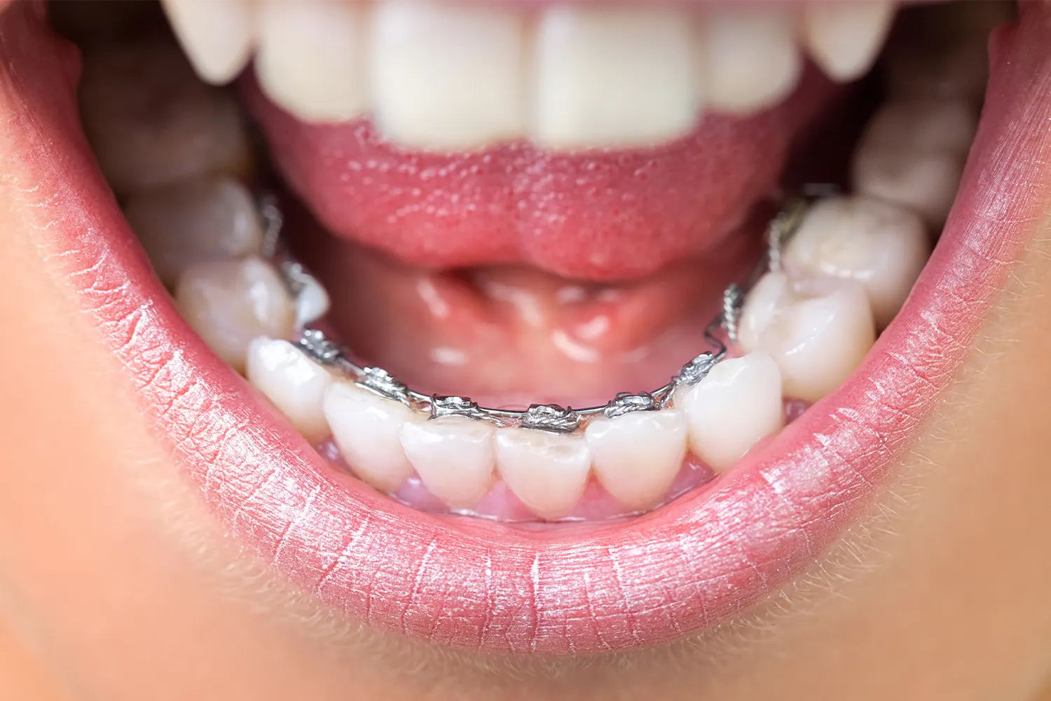 Lingual Braces
