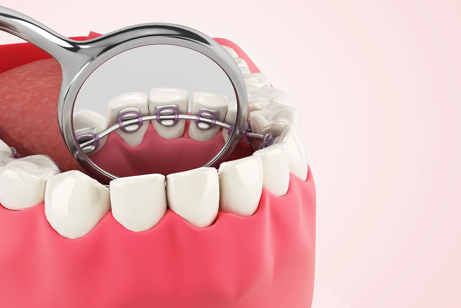 Lingual Braces