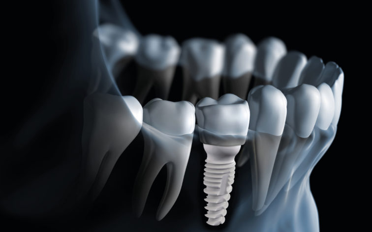 What's Really Happening with Ceramic Implants? A Practical Look at Zirconia