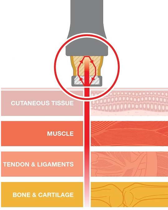Hilterapia, Laseremission, Eindringtiefe, Therapievision Urstein und Hallein
