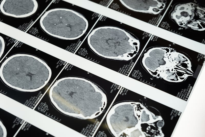 Principales indications de l'IRM cérébrale — pathologies détectées par imagerie du cerveau