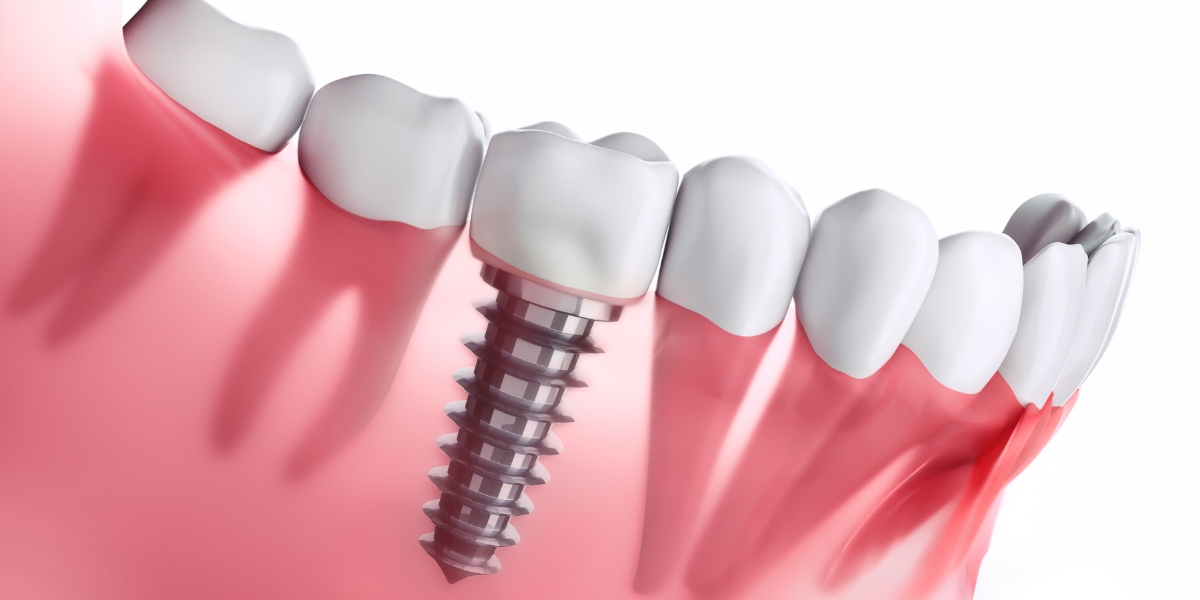 Dental implants procedure at a Busselton clinic showing titanium post placement for permanent tooth replacement