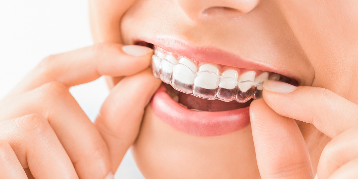 A close-up of an individual placing a clear aligner on their teeth, showcasing the process of clear aligner therapy.