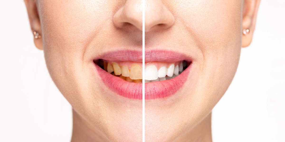Close-up of a woman's smile showing a comparison of teeth before and after whitening, with yellow stained teeth on the left and bright white teeth on the right.