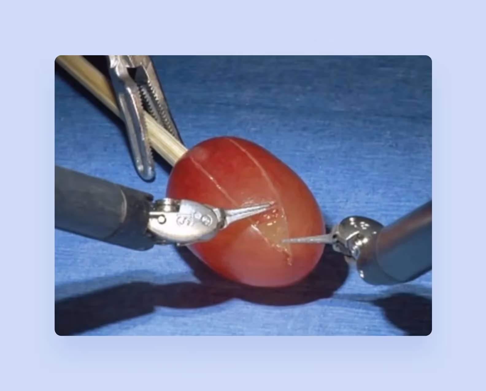 Robotic surgery example
