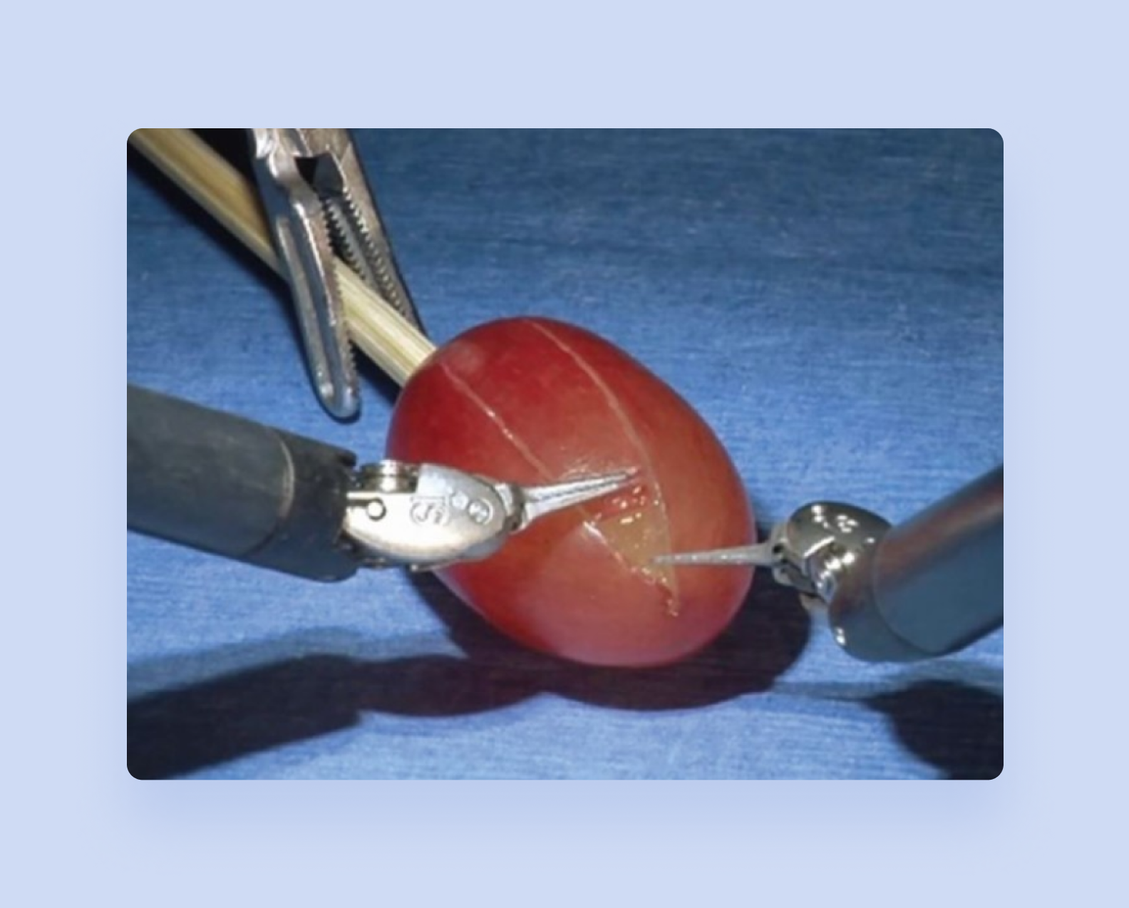 Robotic surgery example