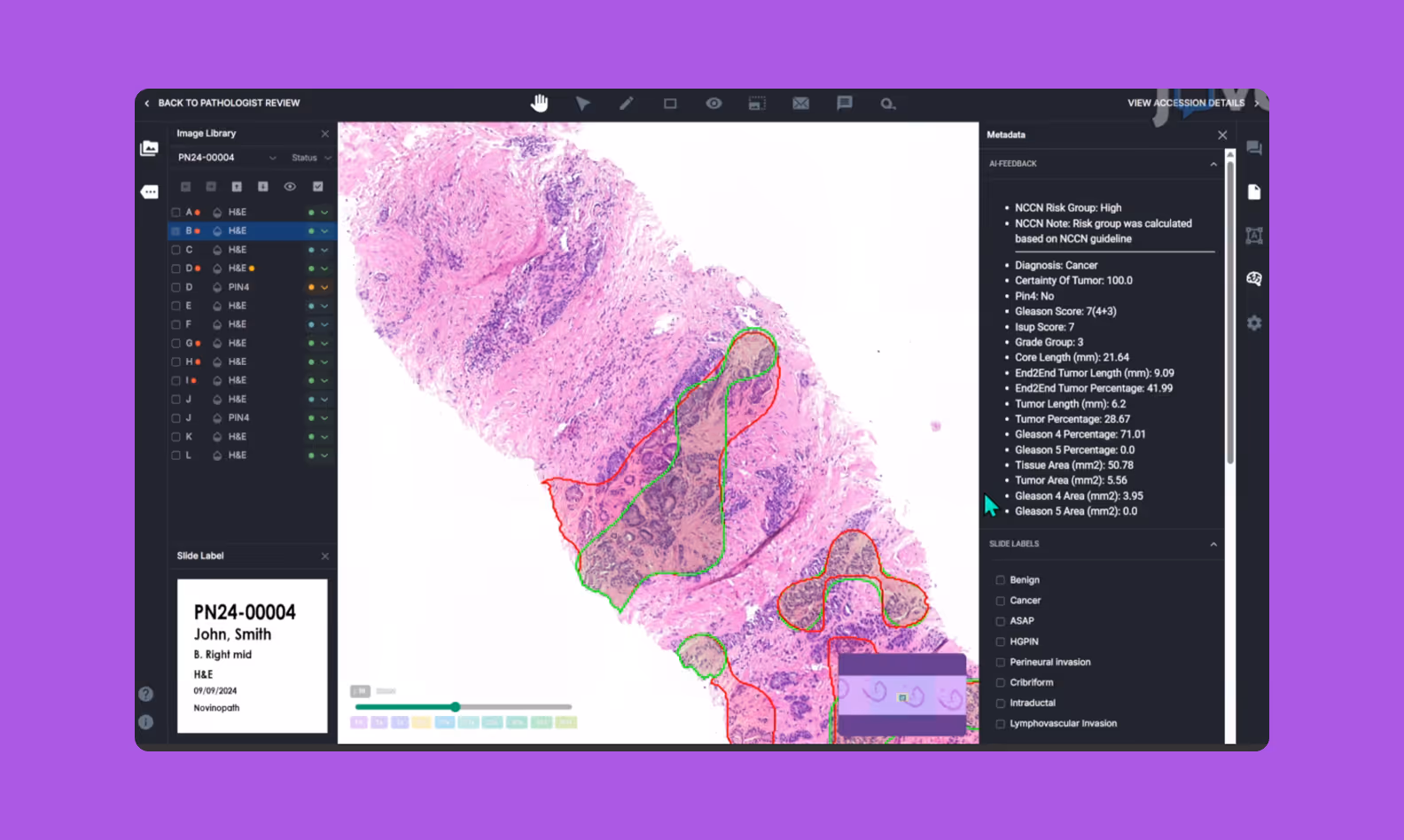 Скриншот интерфейса ИИ-системы с аннотациями на биопсийных слайдах (цветовая сегментация патологий)