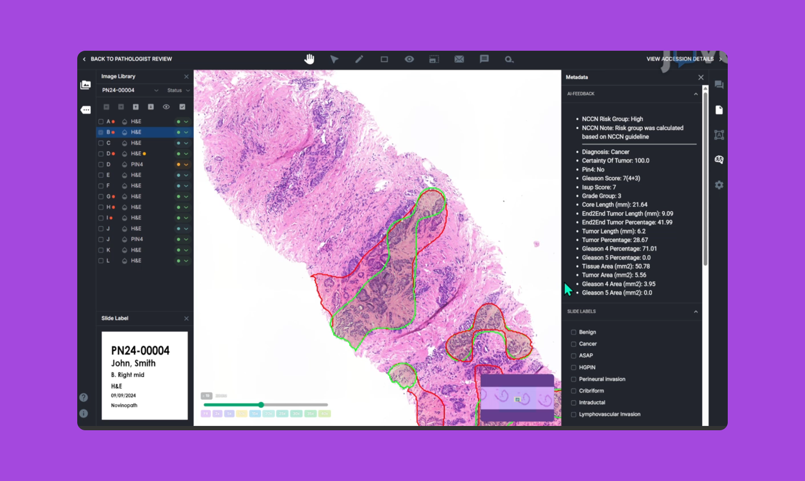 Скриншот интерфейса ИИ-системы с аннотациями на биопсийных слайдах (цветовая сегментация патологий)