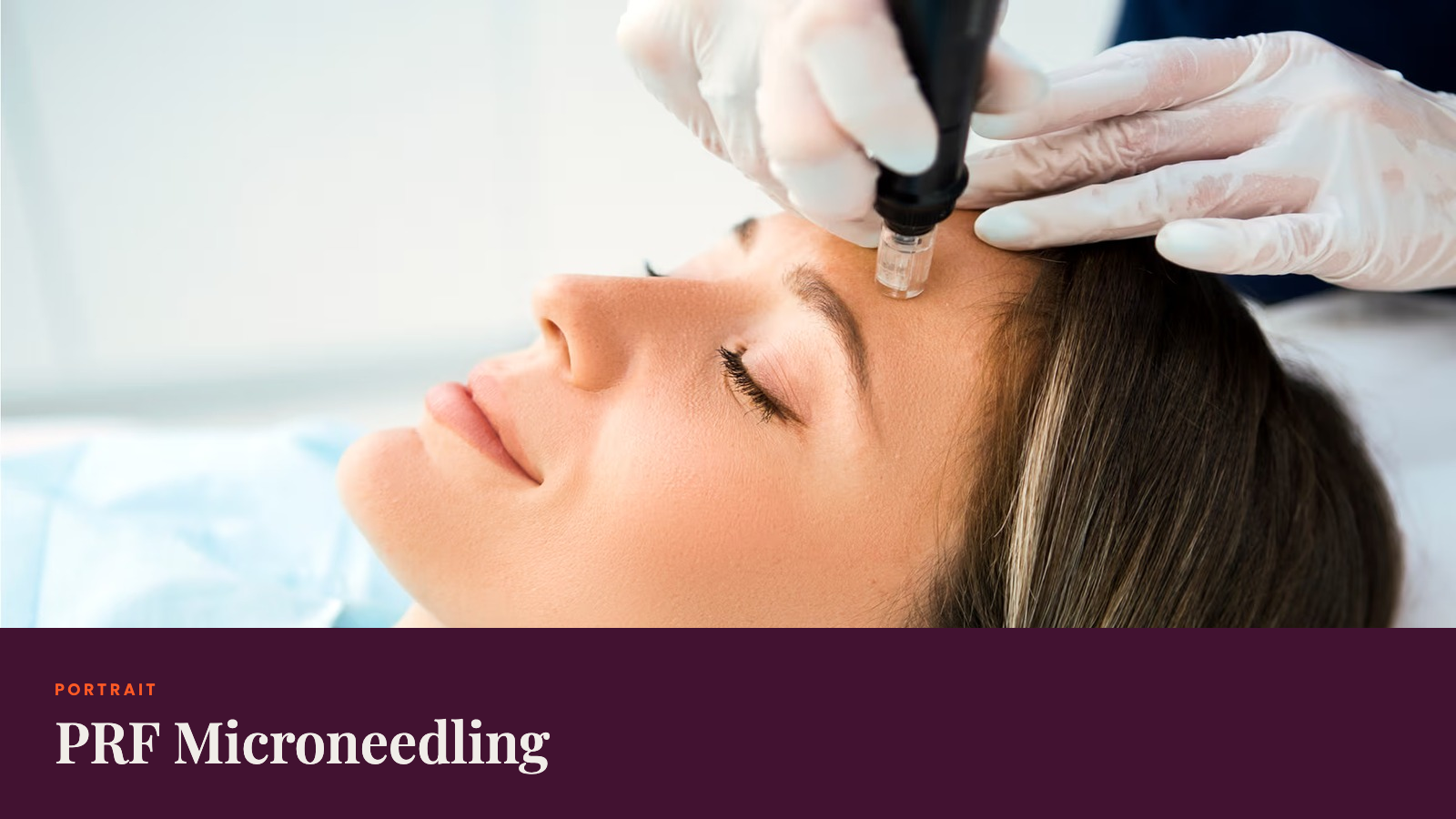 Everything You Need To Know About Microneedling with PRF