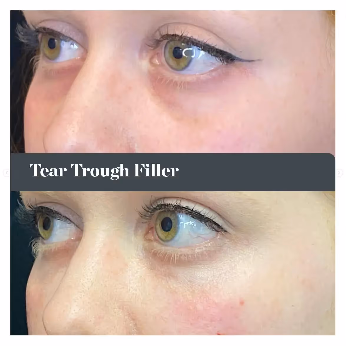 Tear Through Filler