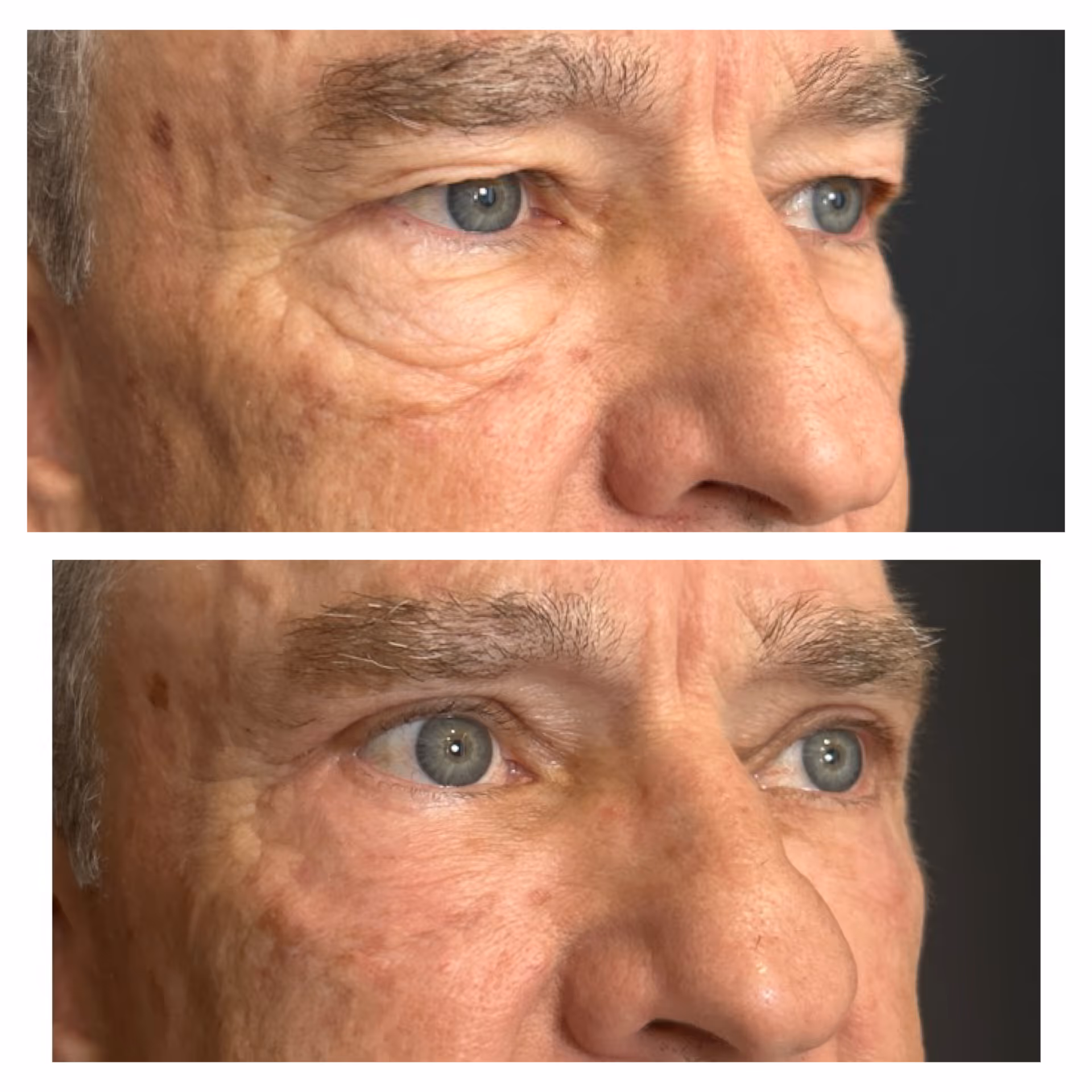 Male Eye Bag Treatment