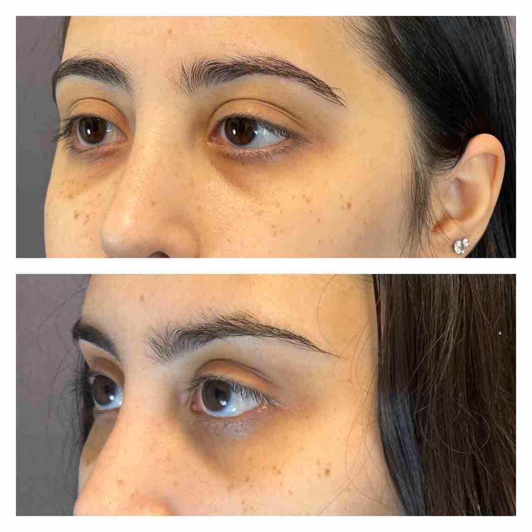 Anatomy of the tear trough area - tear trough filler