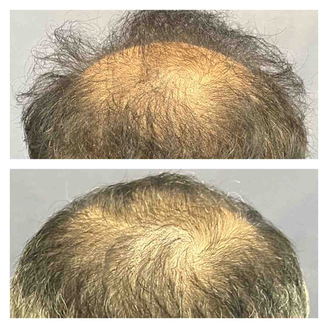 dht blocker for hair growth dht blocker for hair growth