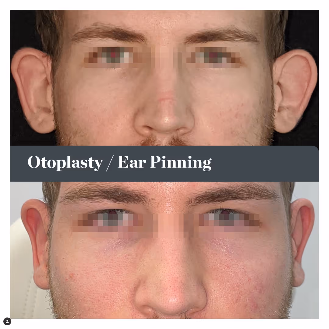 Otoplasty / Ear Pinning