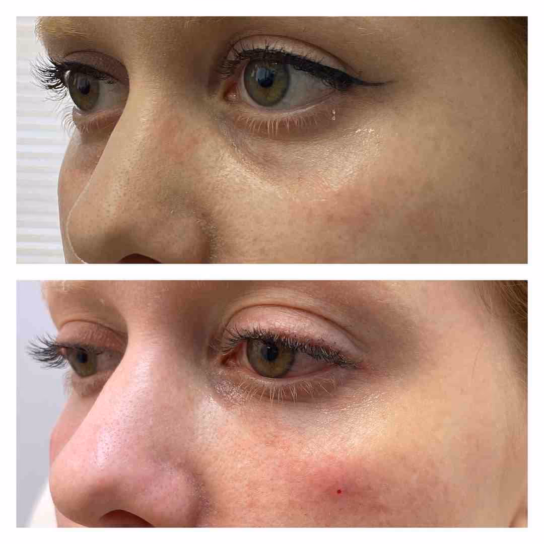 Tear Trough Filler