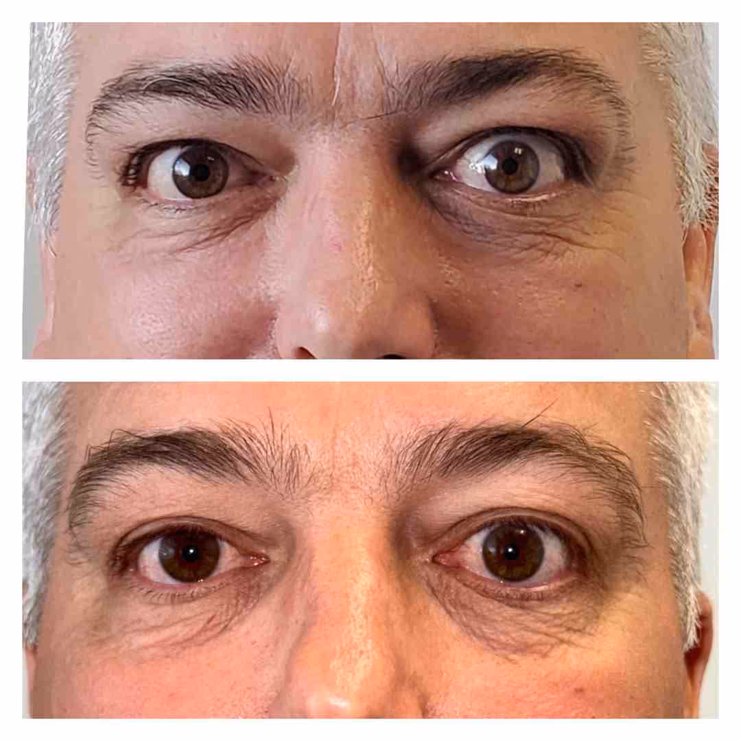 Before and after eyelid surgery - ted eye disease