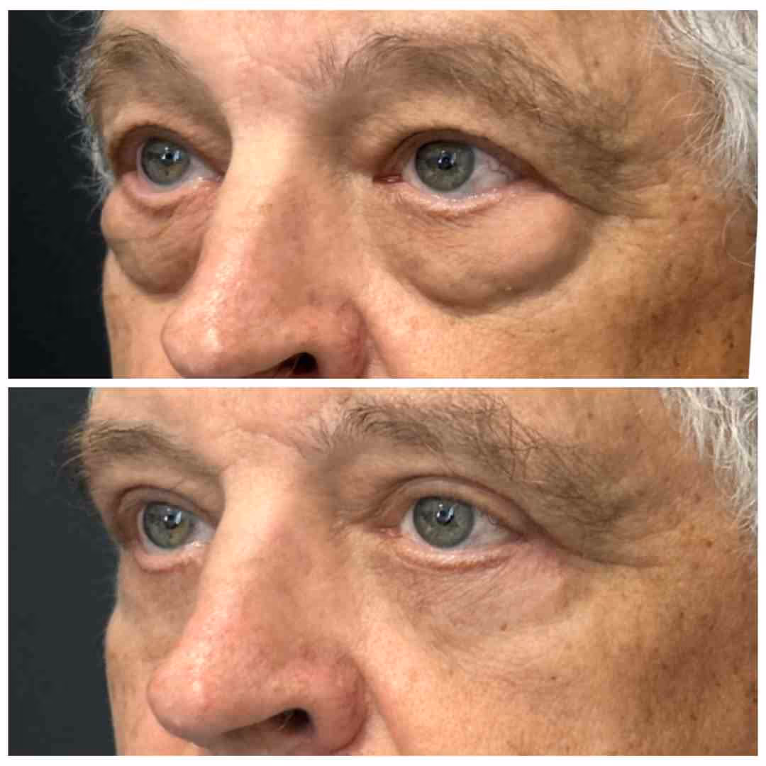 Men eyebags
