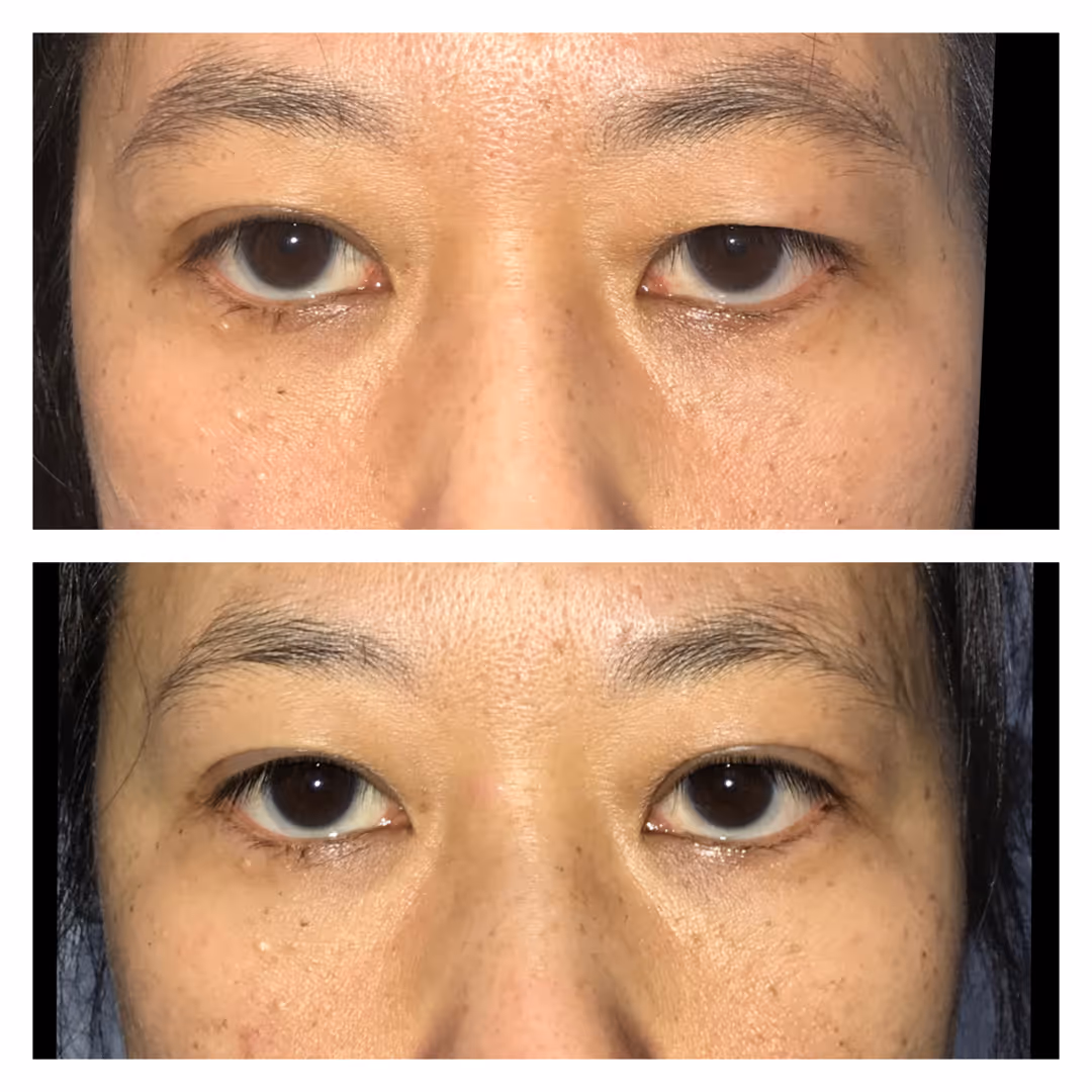 Asian Eyelid Surgery Results