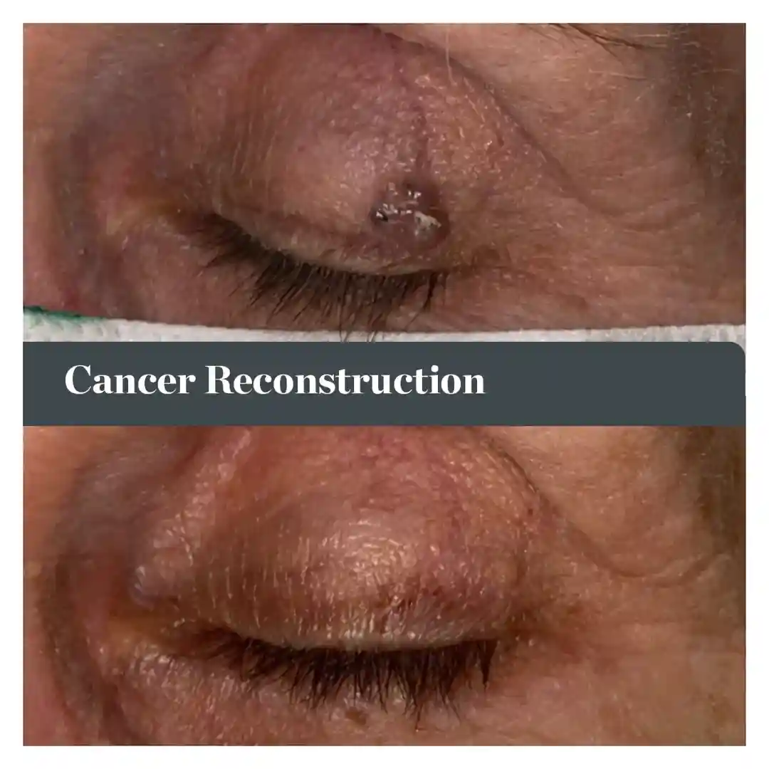 diagram of different symptoms on an eyelid - does skin cancer on eyelid hurt diagram of different symptoms on an eyelid - does skin cancer on eyelid hurt