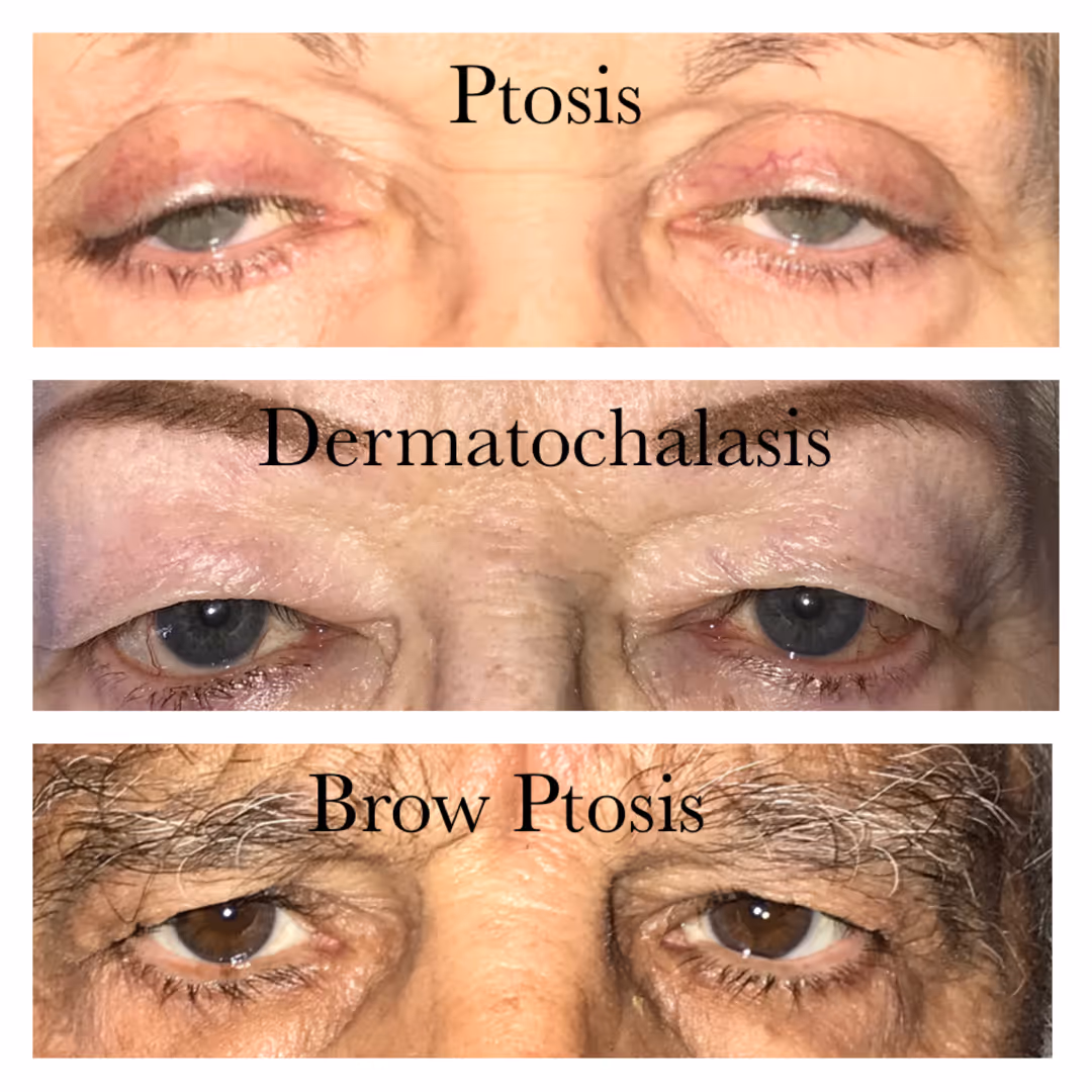 visual field test results - blepharoptosis