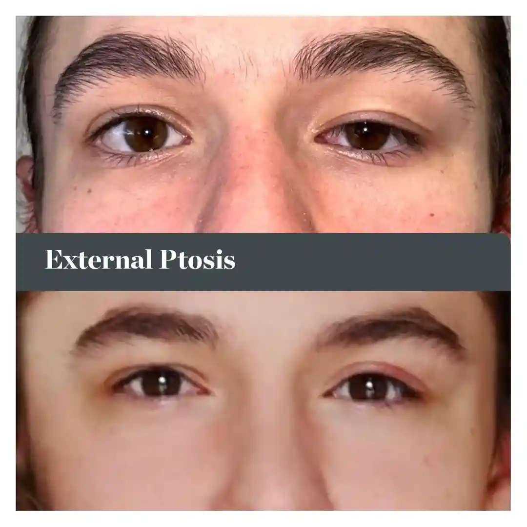 visual field test results - blepharoptosis visual field test results - blepharoptosis