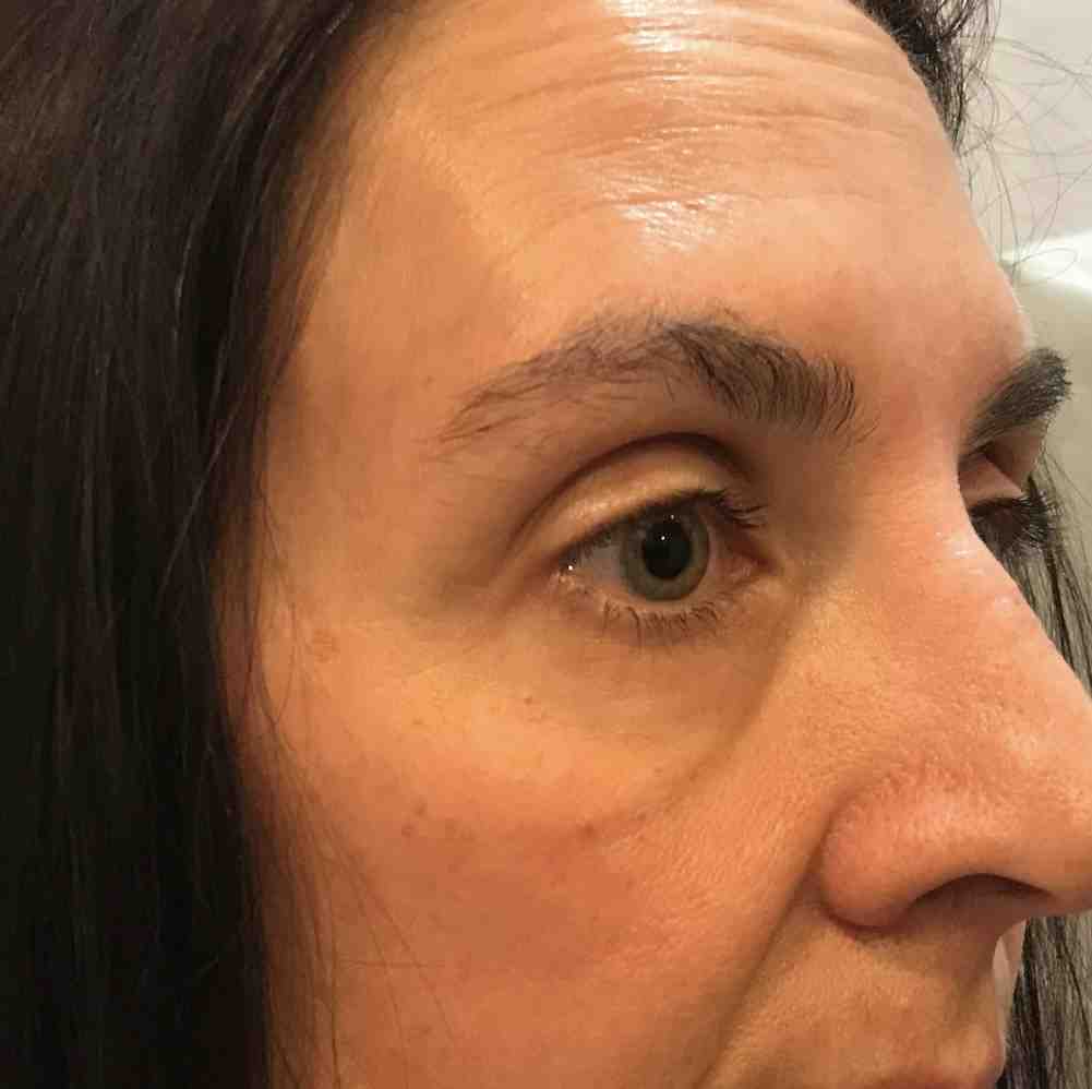 anatomy of the tear trough showing skin, fat pads, and bone structure - does tear trough filler get rid of dark circles