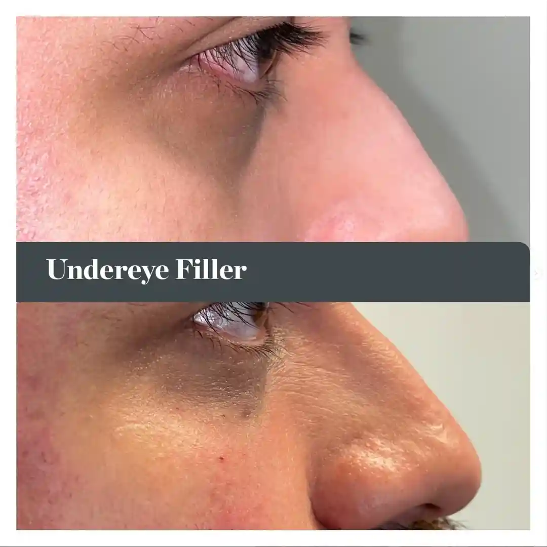 before and after tear trough filler treatment showing reduced dark circles and hollows - does tear trough filler get rid of dark circles
