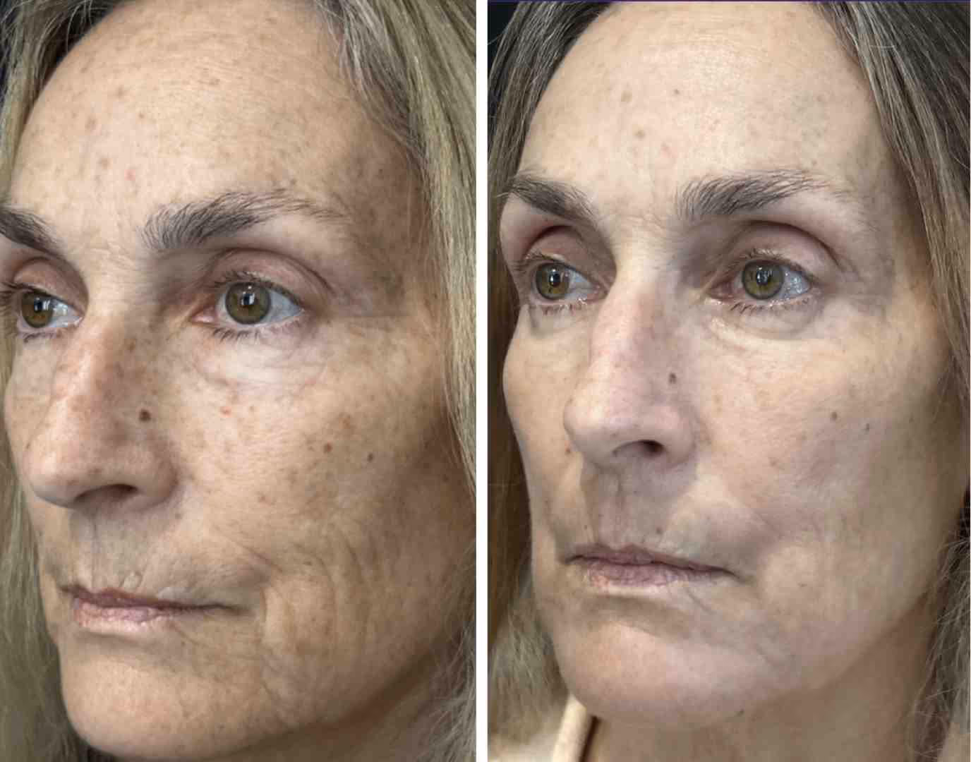 healthy, glowing skin - laser skin treatments