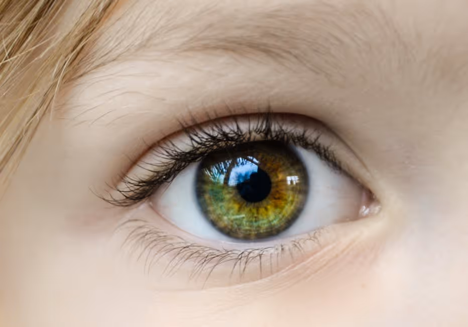 image of a child with ptosis, showing the difference in eyelid position compared to a normal eye - does insurance cover ptosis surgery