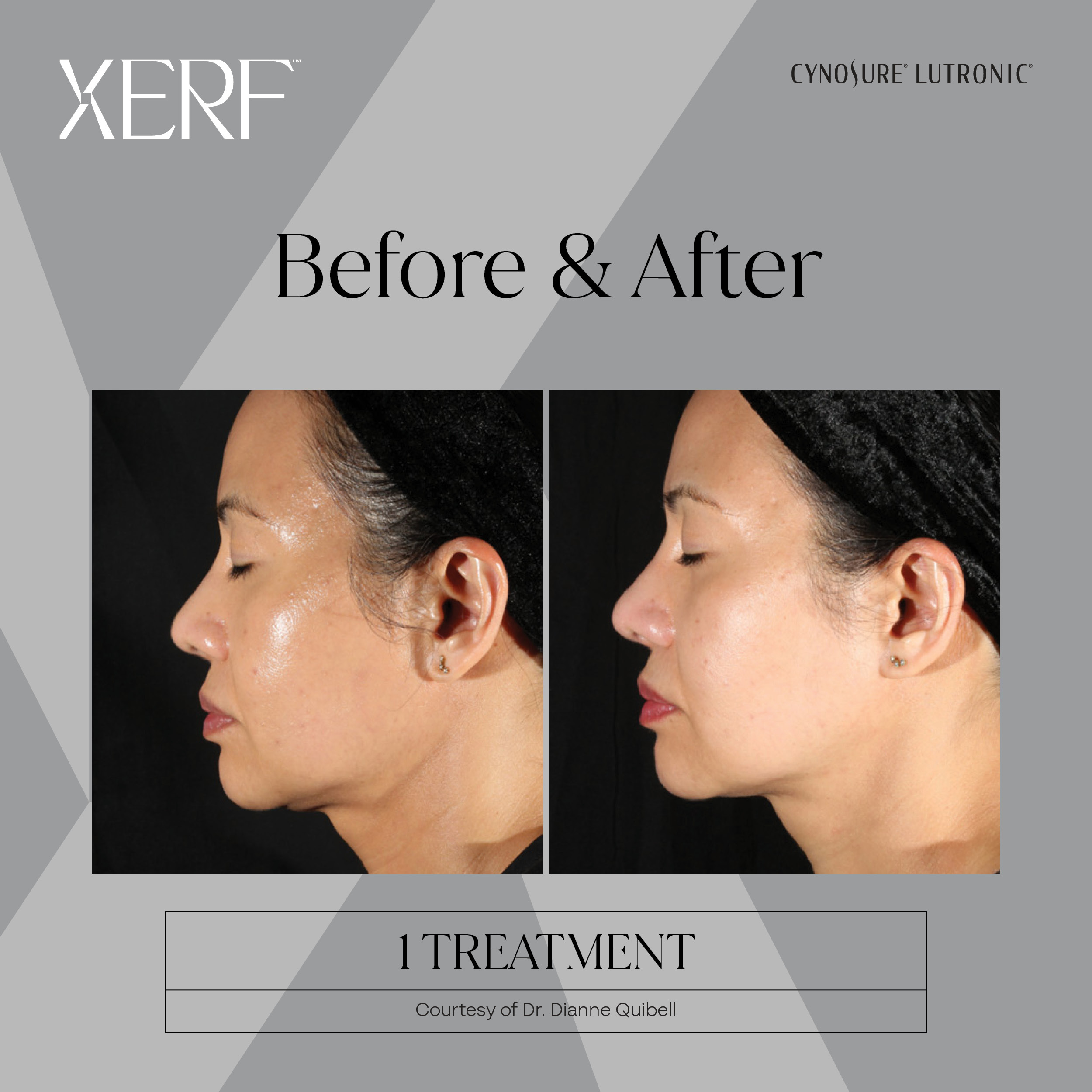 XERF before after