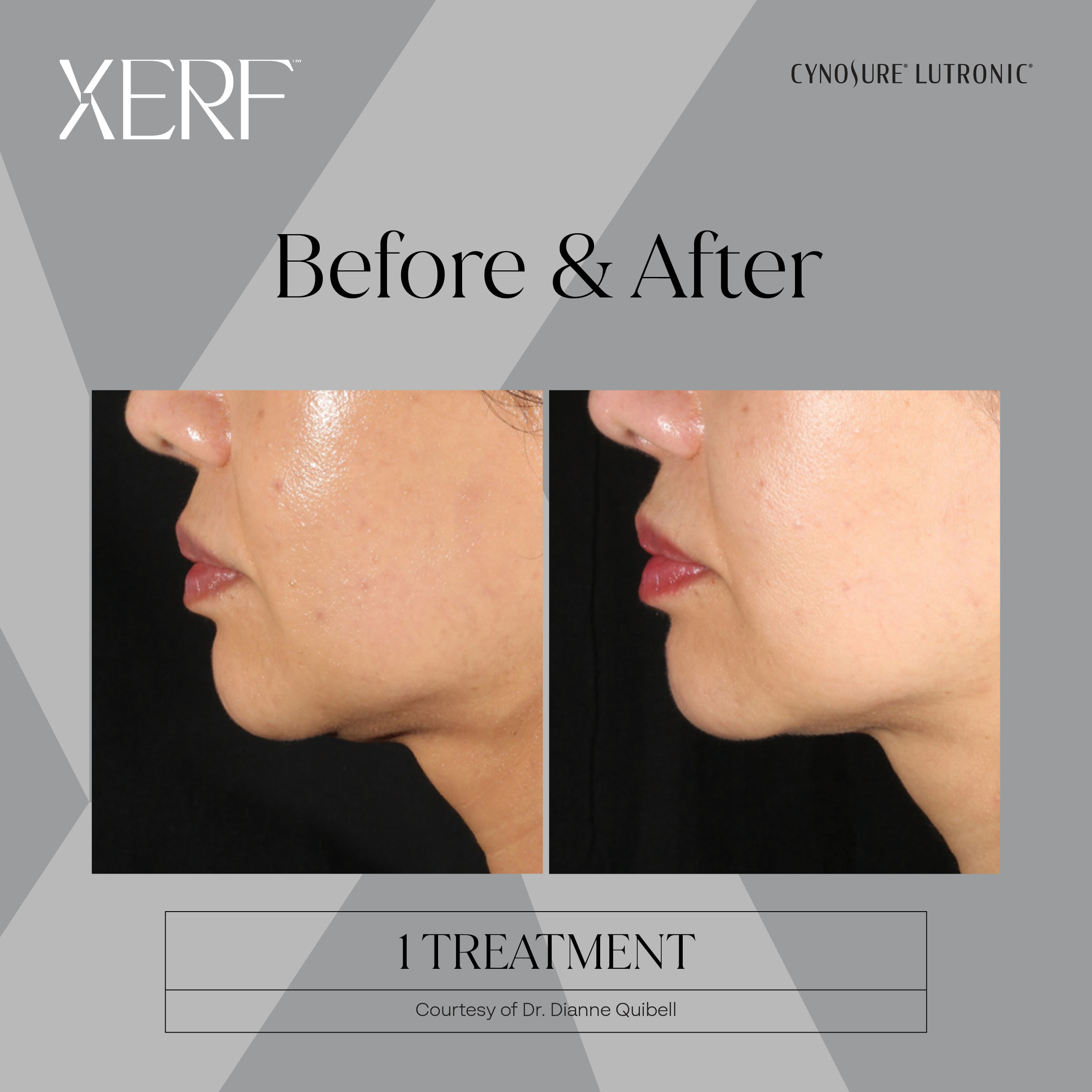 XERF before after