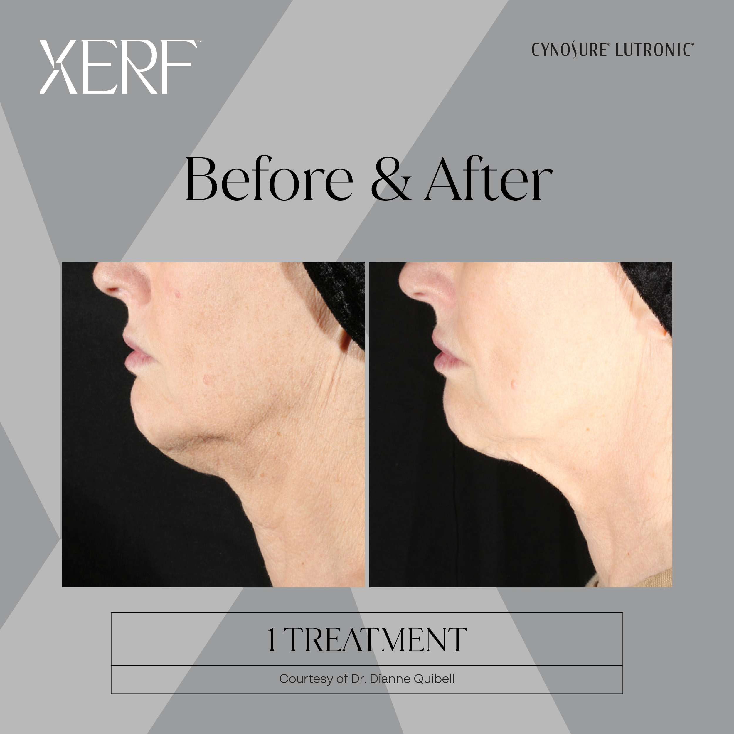 XERF before after
