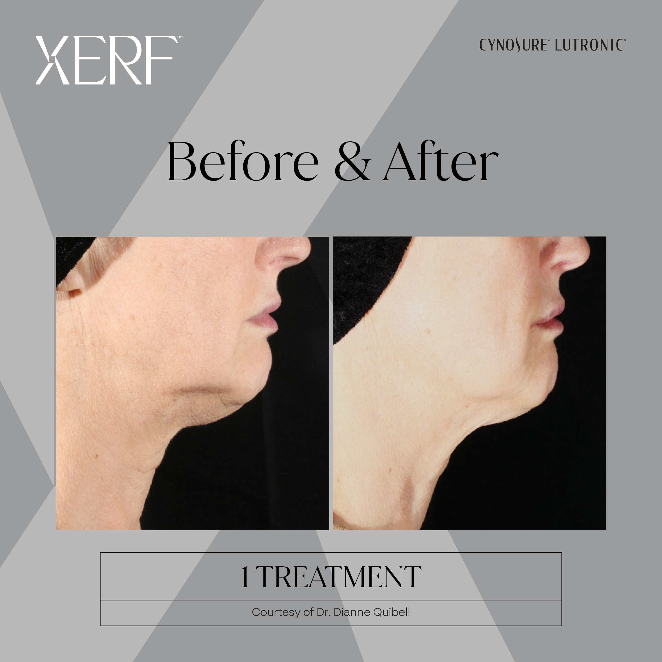 XERF before after