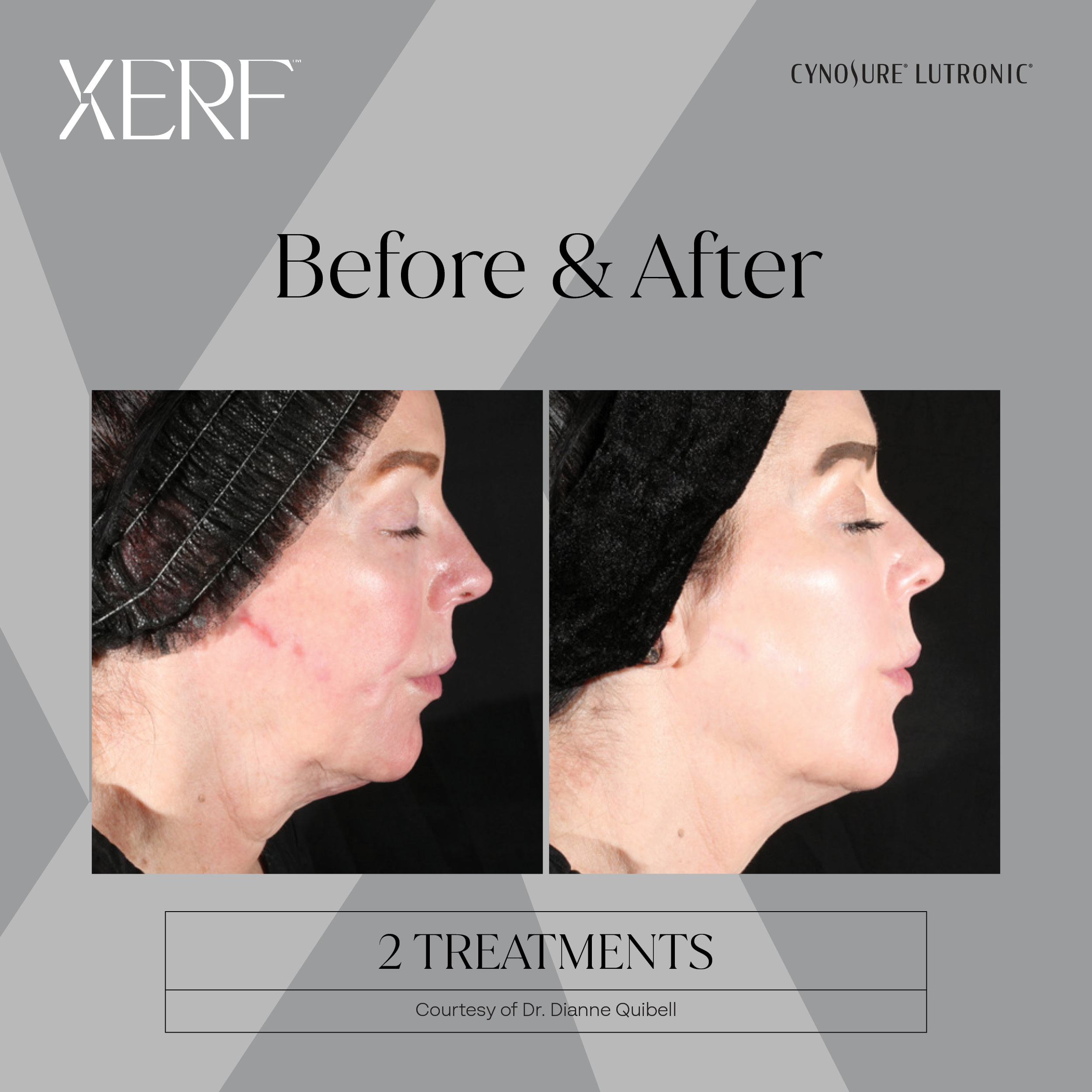 XERF before after