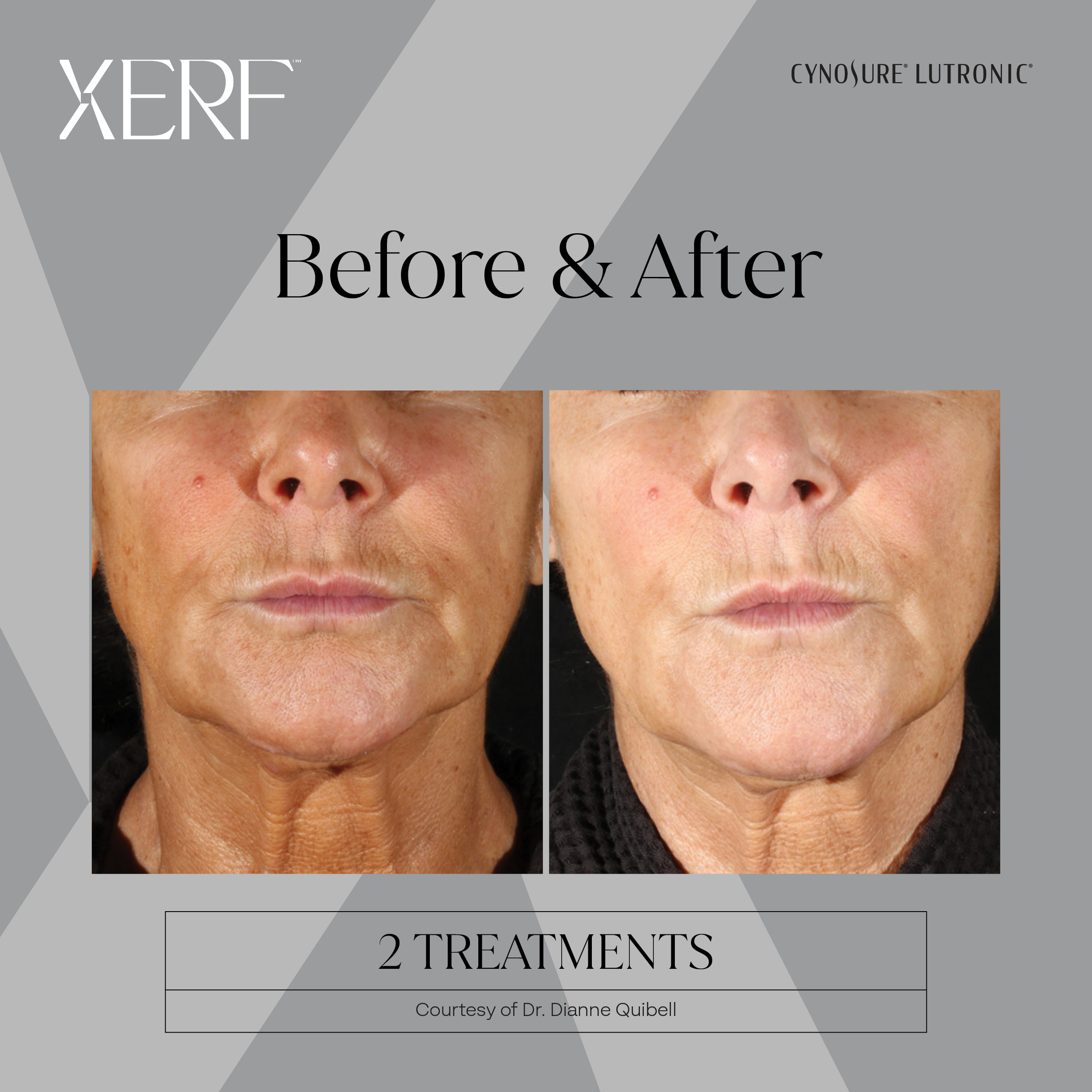 XERF before after