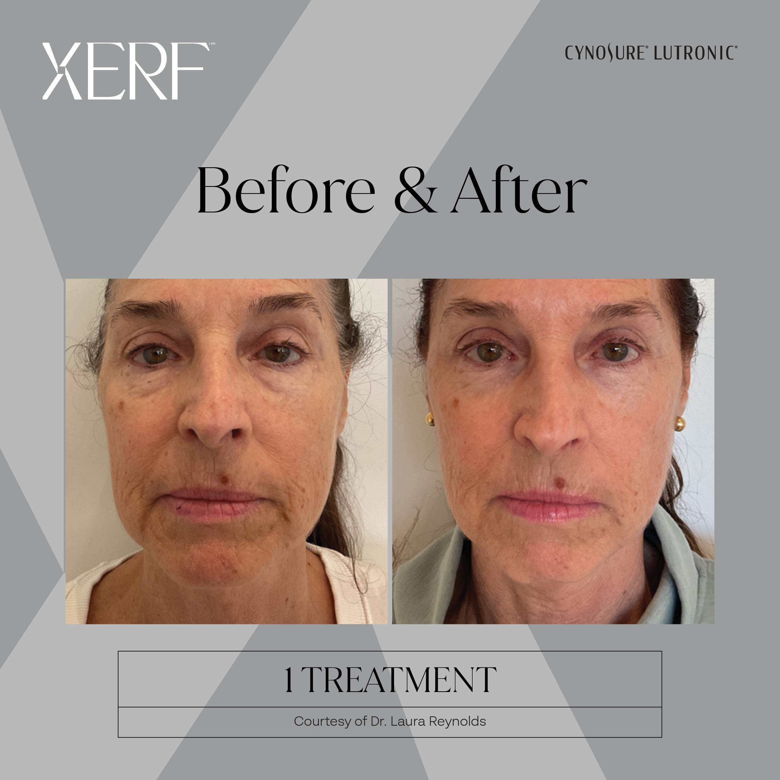 The before and after of a woman's face.