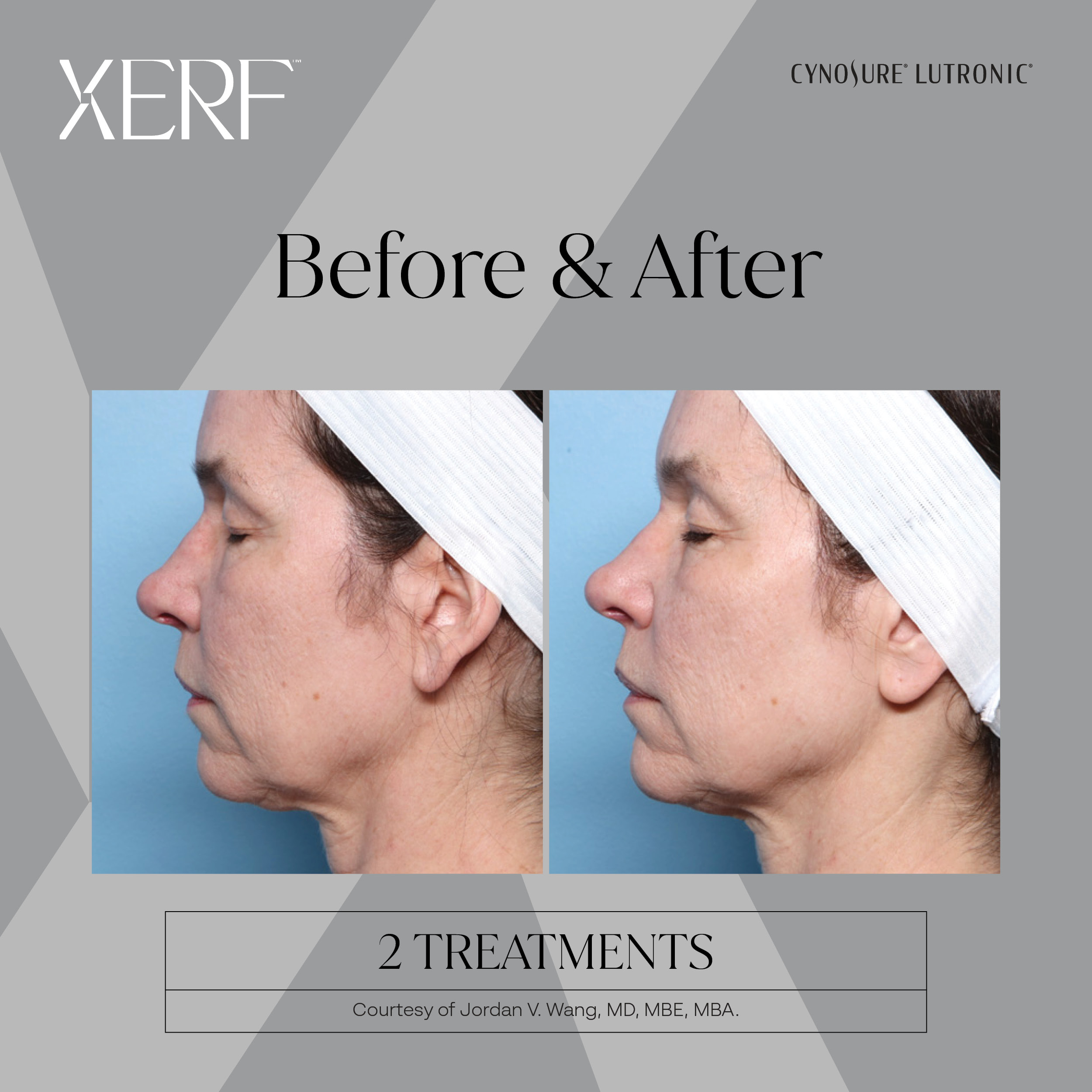 XERF before after