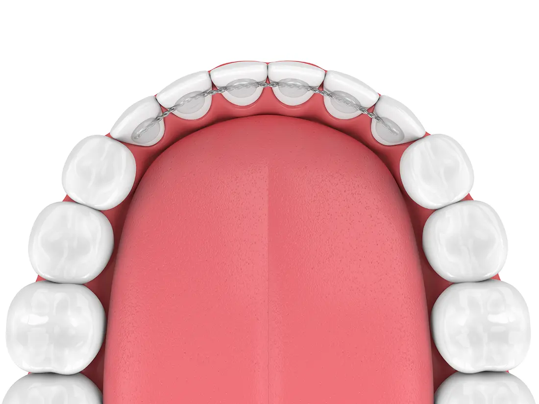 Essix Retainers