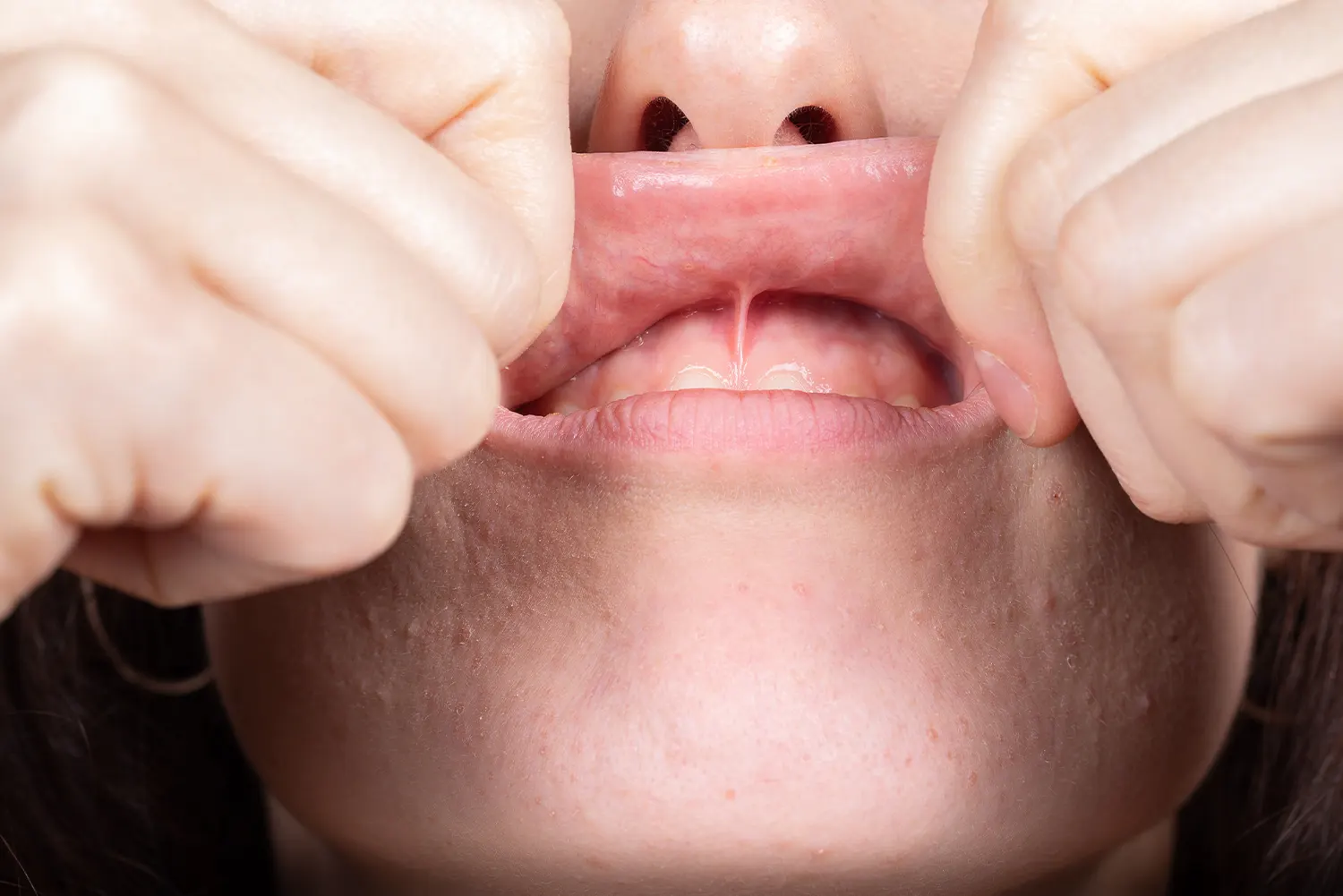 Frenectomy In Tempe, AZ | Evergreen Dental Care
