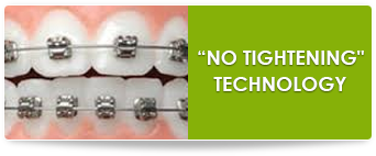 in ovation short term braces