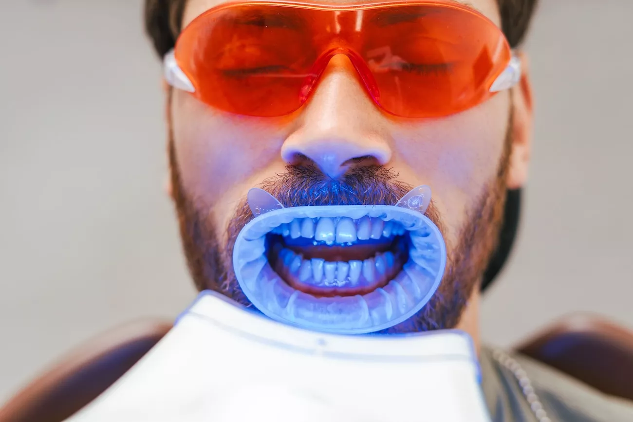 Bearded man in the process of having his teeth whitening.